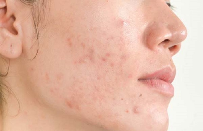 Mặt bị nổi mụn ở da bị dị ứng mỹ phẩm nhẹ