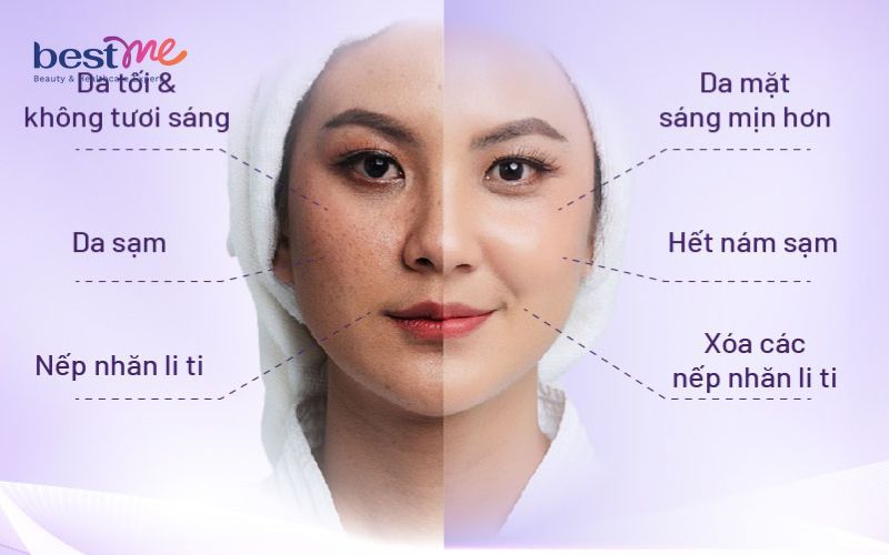 Sự thay đổi của làn da sau khi cấy trắng da mặt