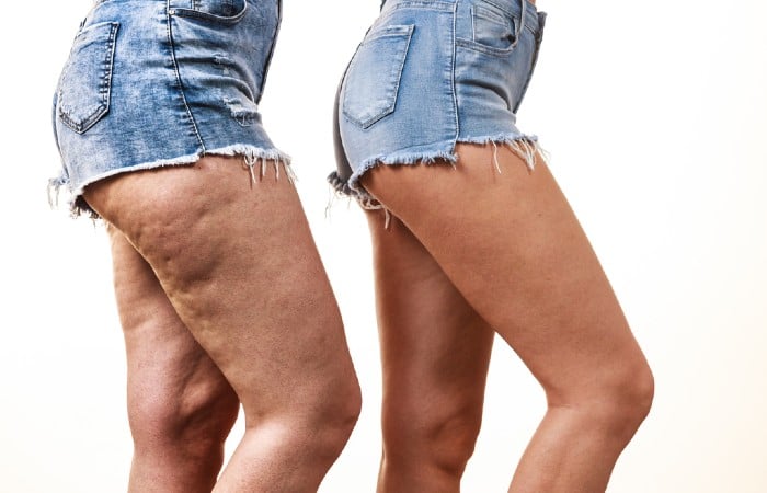 Cellulite gây mất thẩm mỹ cho làn da
