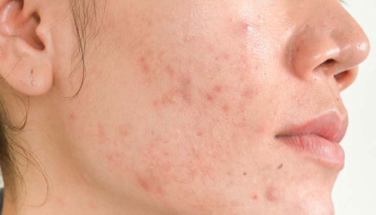 Hỗ trợ điều trị các tình trạng viêm da mặt