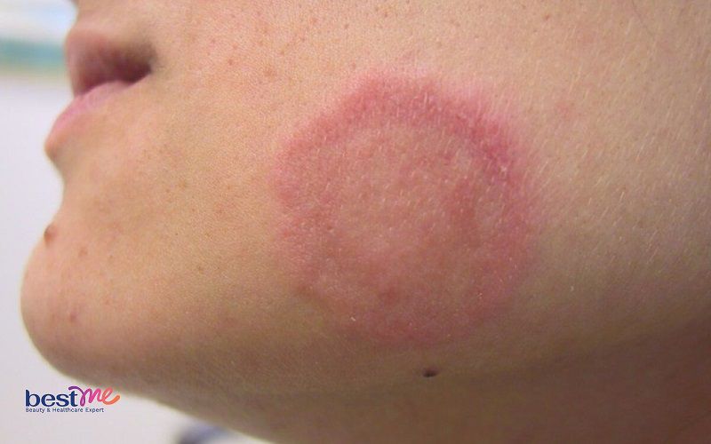 Một số dấu hiệu chàm da người lớn và trẻ nhỏ