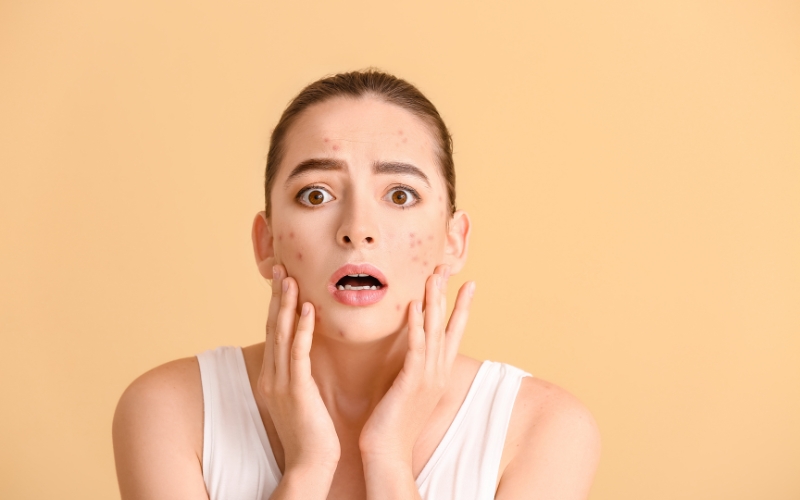 Nguyên nhân khiến làn da bị mụn ẩn