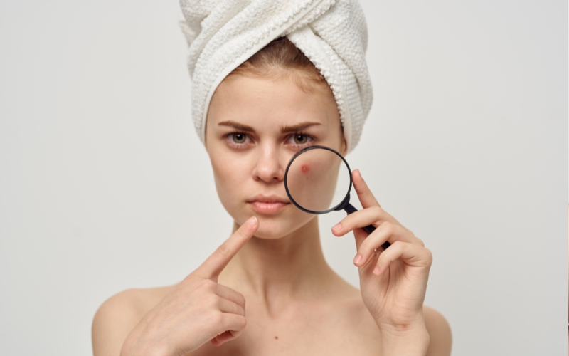 Một vài lưu ý khi chăm sóc da bị mụn ẩn