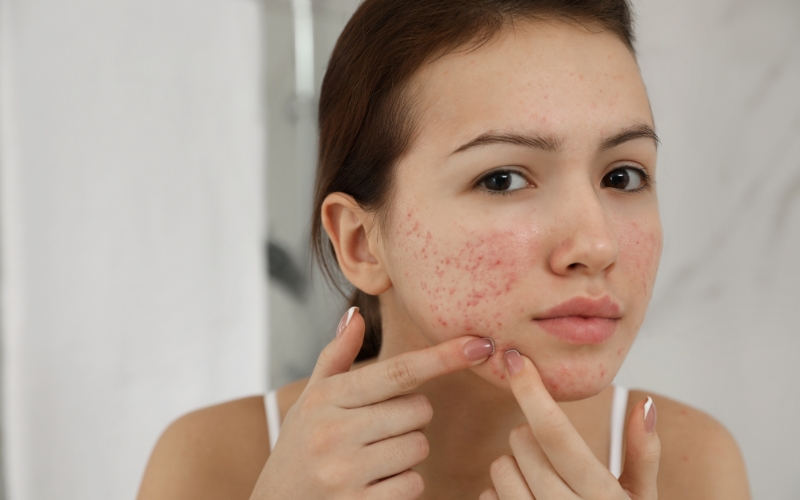 Đặc điểm của làn da bị mụn ẩn