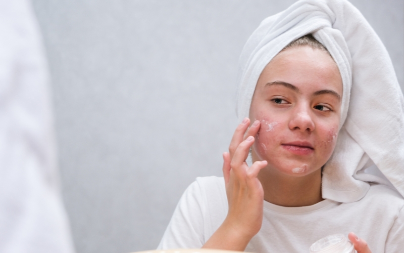 Thoa kem dưỡng trị mụn ẩn
