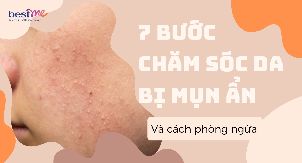 7 bước chăm sóc da bị mụn ẩn và các cách phòng ngừa