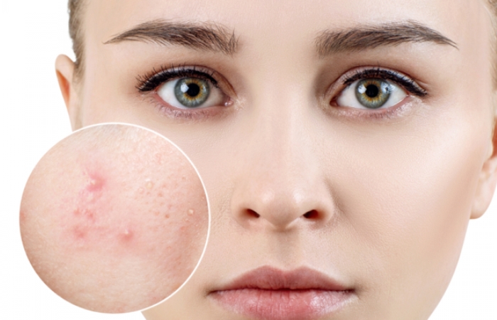 Đặc điểm của da mụn là gì?