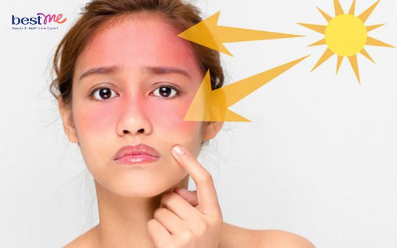 Tình trạng da thường gặp vào mùa hè