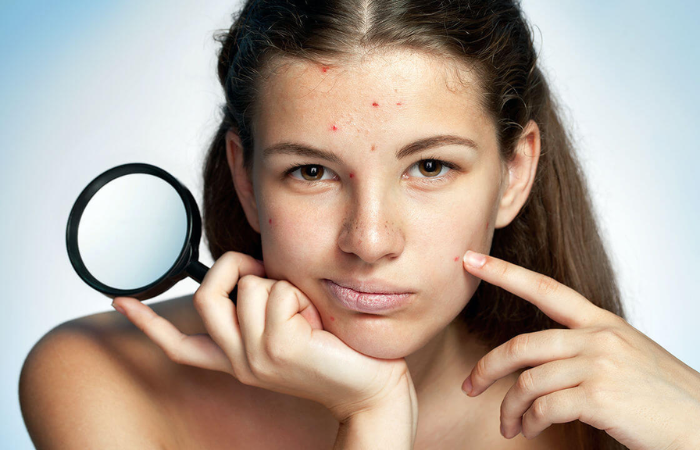 Chăm sóc da sau khi nặn mụn là rất quan trọng để làn da sớm khỏe mạnh