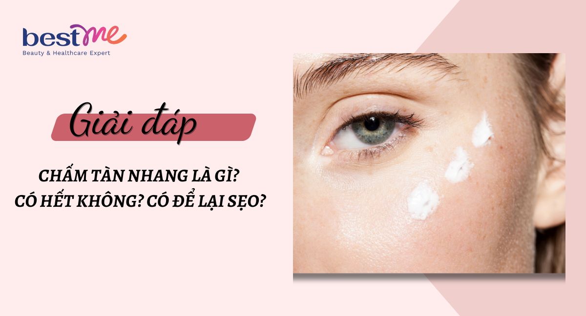 Chấm tàn nhang là gì? Có hết không? Có để lại sẹo?