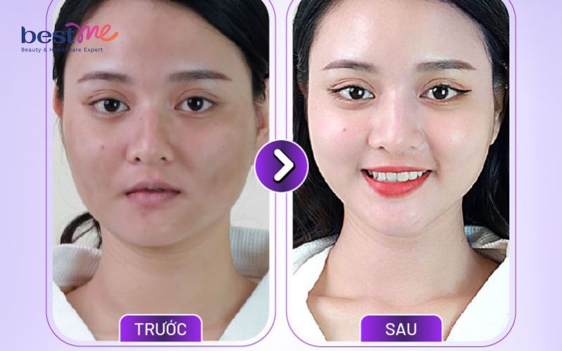 Thời gian hiệu quả thường kéo dài từ 6-12 tháng