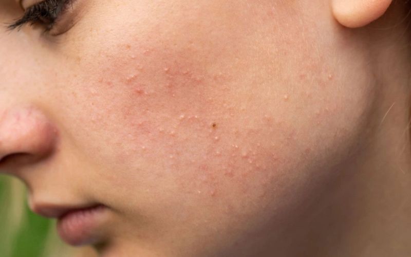 co-nen-nan-mun-sau-khi-peel-da-khong-thoi-diem-nen-nan-mun-2 Có nên nặn mụn sau khi Peel da không? Thời điểm nên nặn mụn - 2