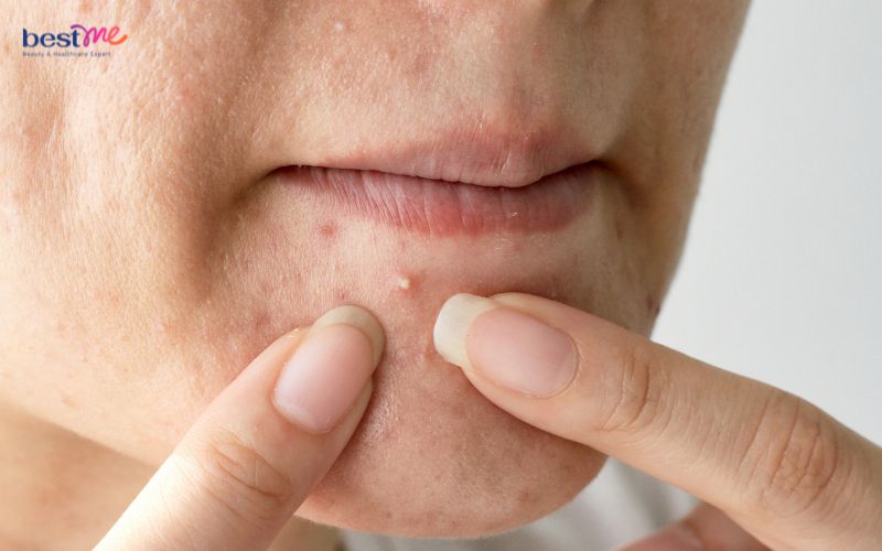 co-nen-nan-mun-trung-ca-khong-vi-sao-va-cach-nan-an-toan-3 Có nên nặn mụn trứng cá không? Vì sao và cách nặn an toàn - 3