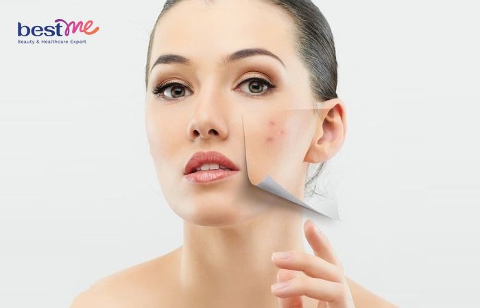 Cải thiện da mụn hiệu quả