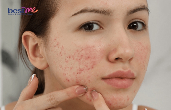 Một trong những nguyên nhân phổ biến làm da bị mỏng đỏ là mụn