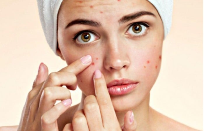 Làn da mụn làm chị em mất sự tự tin