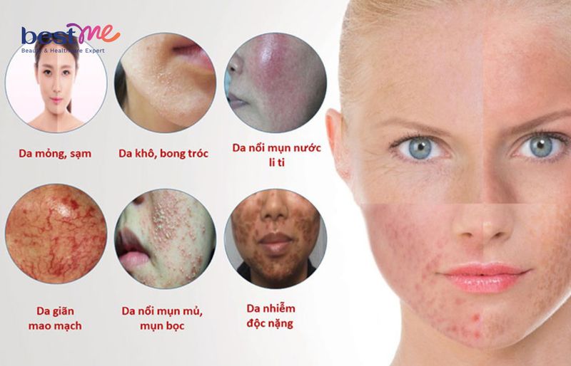 Dấu hiệu nhận biết da bị nhiễm corticoid
