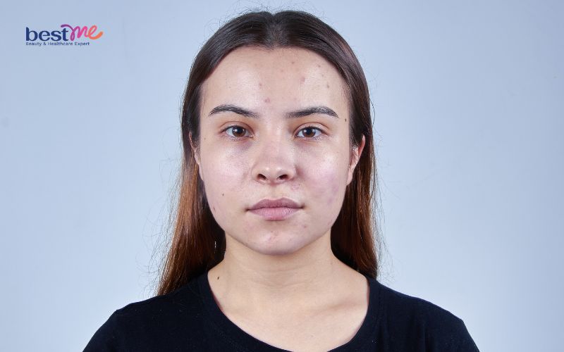 Da dầu có cần dưỡng ẩm không? Có nên dùng kem dưỡng ẩm? - 3