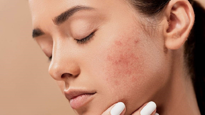 Da khô mụn là gì? Nguyên nhân khiến da mặt khô bị mụn