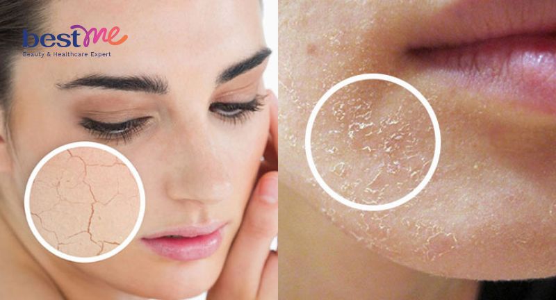 Da mặt bị bong tróc vảy trắng là bệnh gì? Nên làm gì để hết?