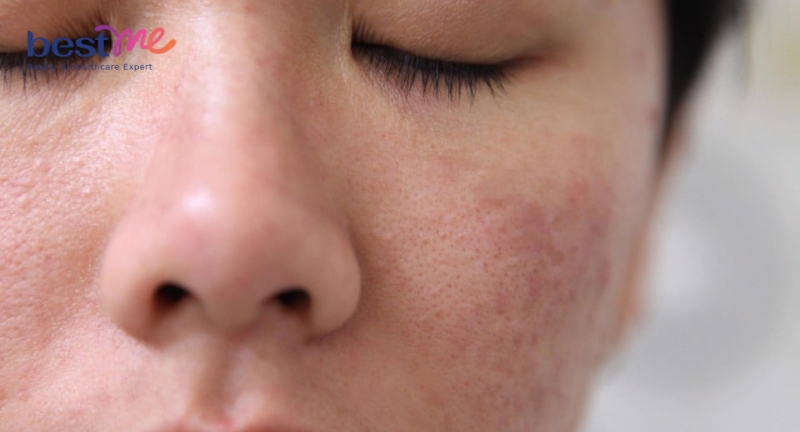 Da mặt bị sần sùi: 12 nguyên nhân & 8 cách chữa trị triệt để