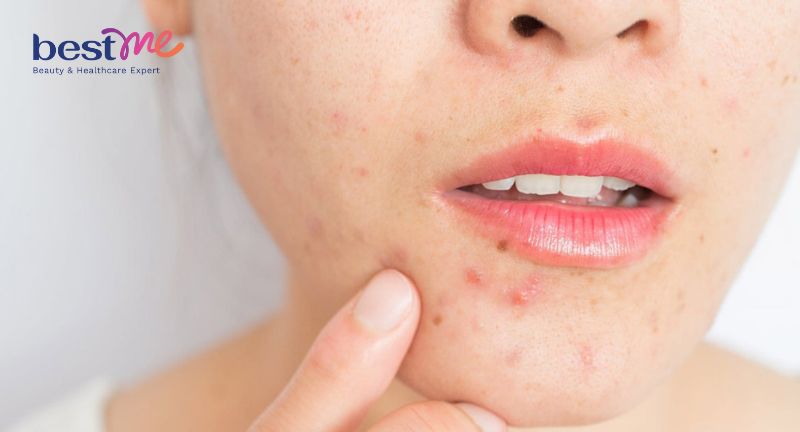 Vì sao da mặt đột nhiên nổi nhiều mụn? Cách trị nhanh nhất