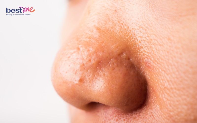 Thế nào là da mặt sần sùi lỗ chân lông to?