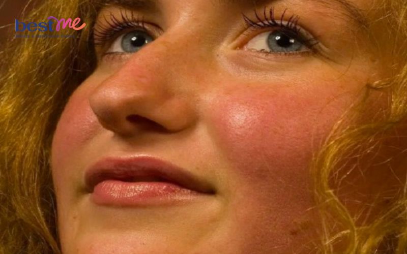 Da mặt ửng đỏ 2 bên má là dấu hiệu của bệnh gì? - 1