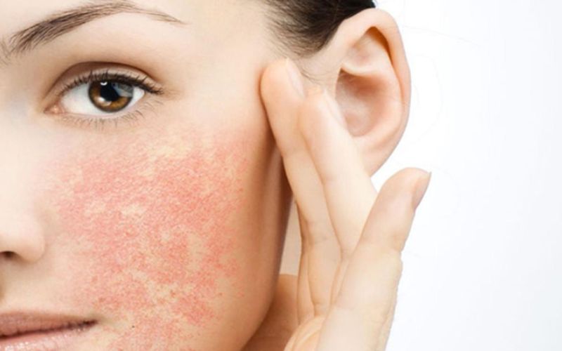 Đặc điểm của làn da nhạy cảm