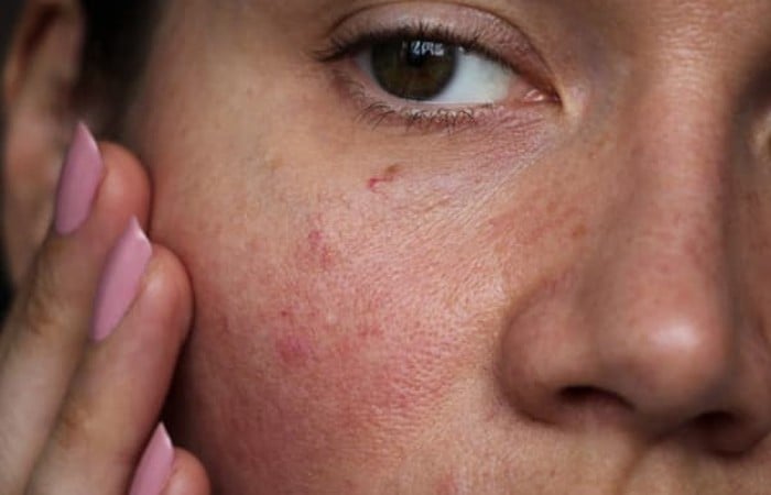 Da xấu đi trước ngày cưới là do đâu?