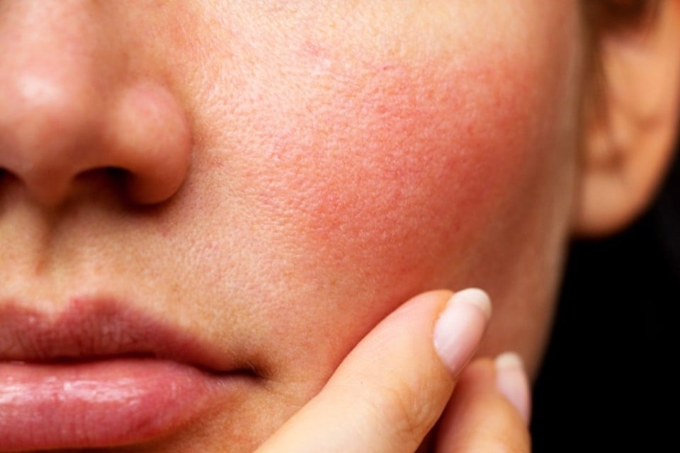 Các thành phần tuyệt đối không được xuất hiện trong mỹ phẩm cho da nhạy cảm