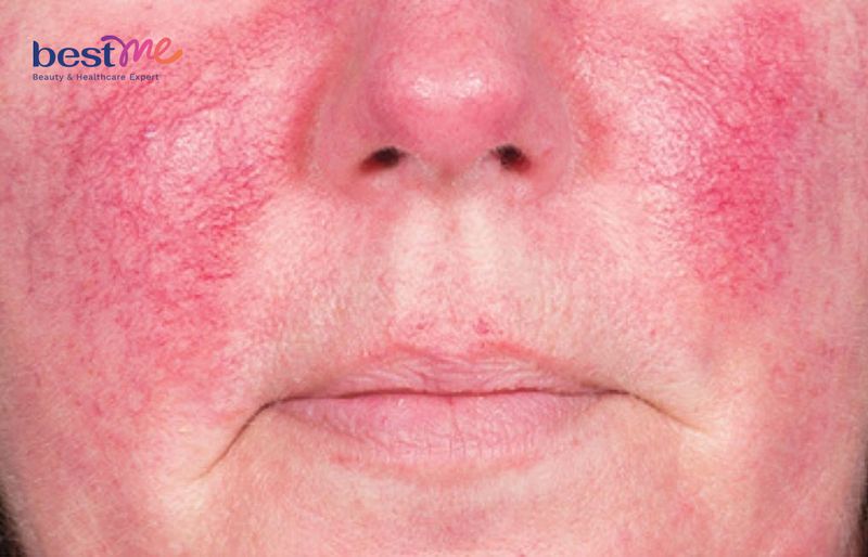 Da bị nhiễm corticoid bị tổn thương nặng nề nên cần phục hồi ngay lập tức