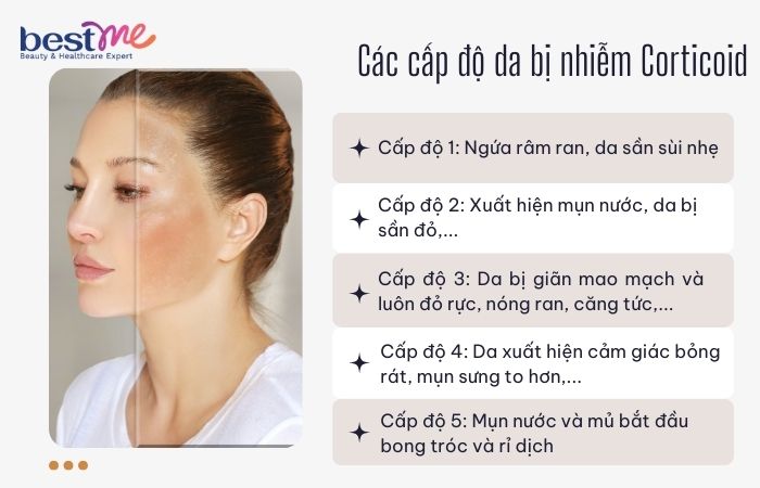 Các cấp độ làn da bị nhiễm corticoid