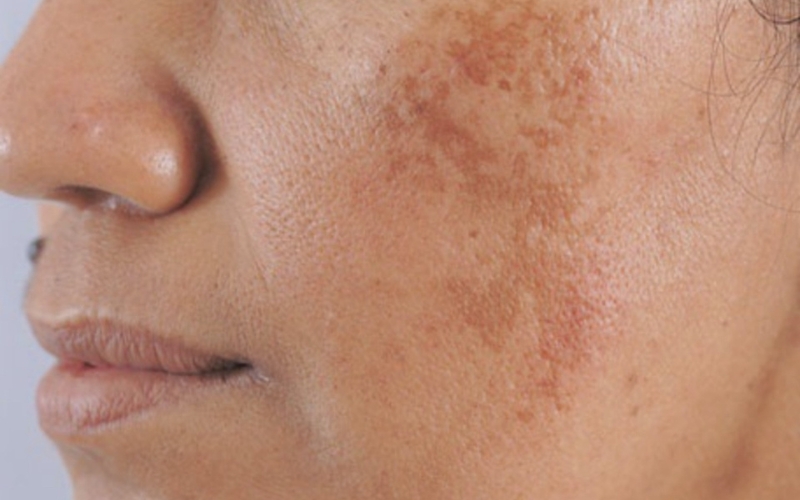 Da sạm là tình trạng tăng sắc tố trên da