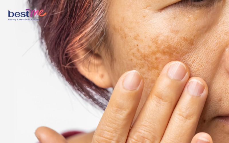 Sạm da màu cũng là một dấu hiệu của da lão hóa