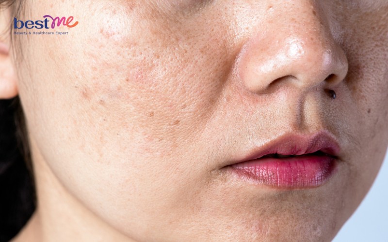 Thiếu nước, thiếu ẩm khiến da khô sạm