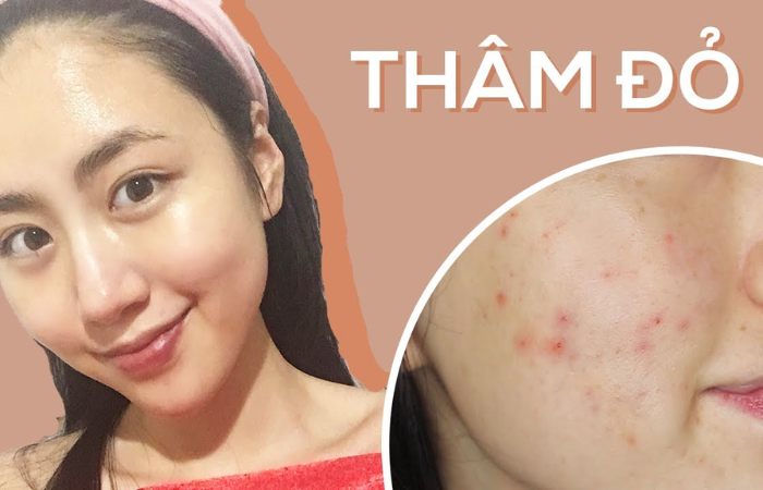 Chúc chị em sớm cải thiện tình trạng thâm đỏ!