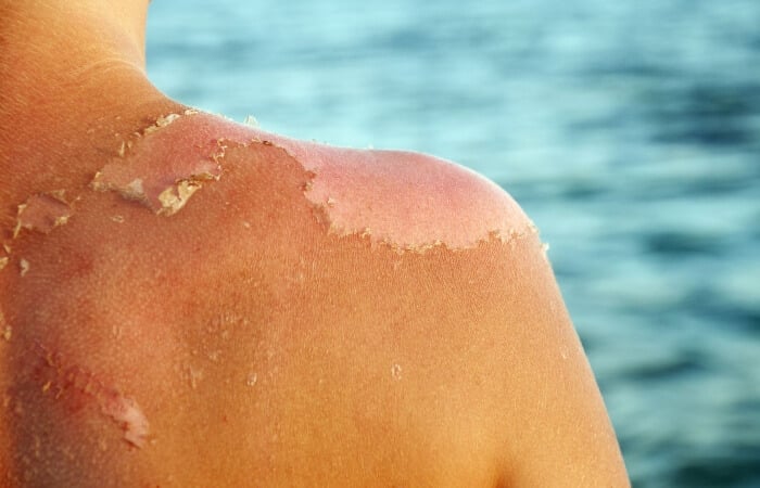 Da bong tróc cũng là một dấu hiệu của làn da bị cháy nắng