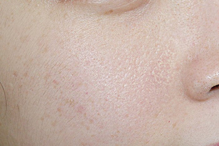 5 cách trị da mặt sần vỏ cam cho làn da khỏe đẹp, mịn màng