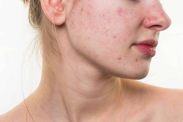 da mặt bị ngứa sần là một trong những biểu hiện của dị ứng mỹ phẩm 