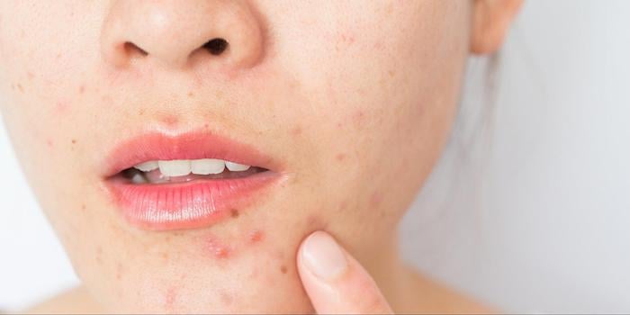 Nguyên nhân da mặt sần sùi mụn ẩn hiệu quả và lợi ích