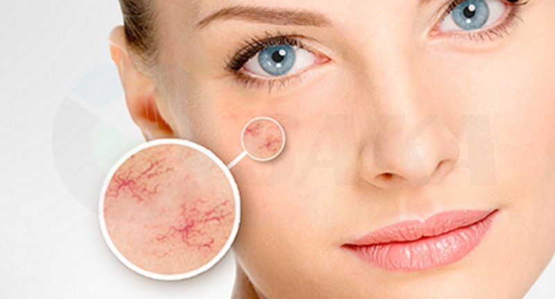 Làn da bị vỡ mao mạch