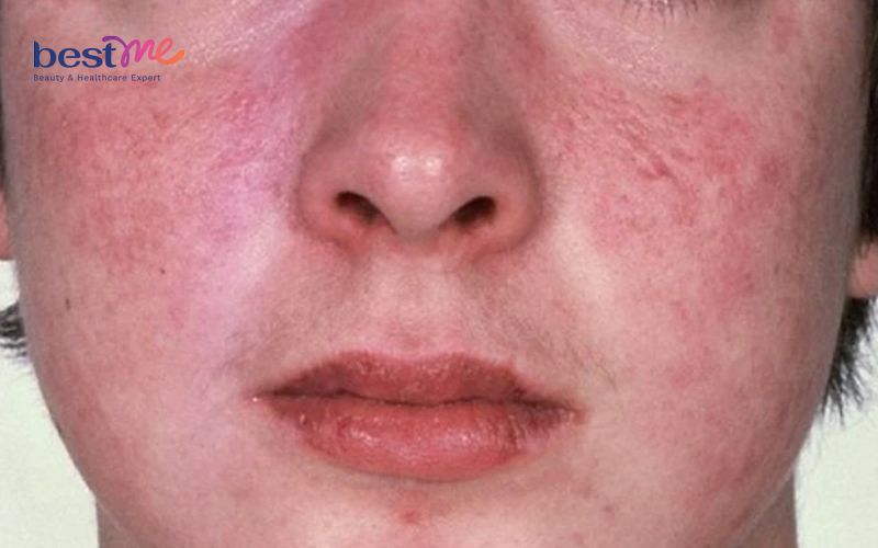 Da mặt ửng đỏ 2 bên má là dấu hiệu của bệnh gì? - 3