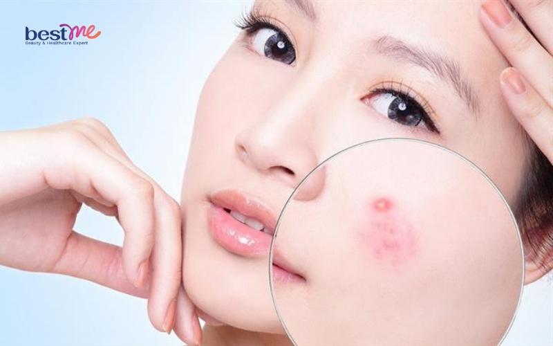 dau-hieu-mun-nhot-bi-nhiem-trung-va-cach-tri-hieu-qua-nhat-1 Dấu hiệu mụn nhọt bị nhiễm trùng và cách trị hiệu quả nhất - 1