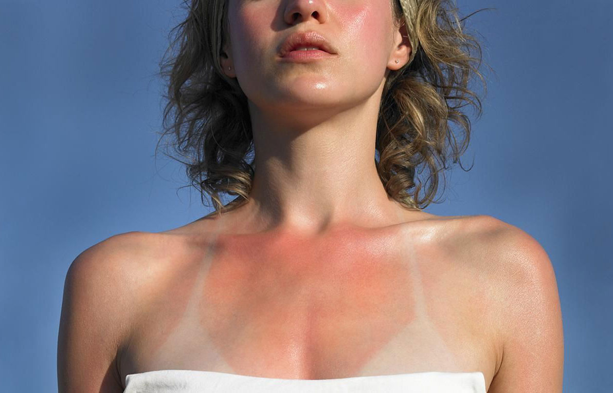 Dấu hiệu nhận biết da bị cháy nắng