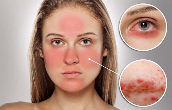 Làn da khi bị kích ứng mẩn