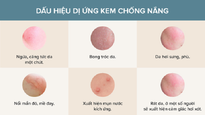 Các dấu hiệu nhận biết bị dị ứng kem chống nắng