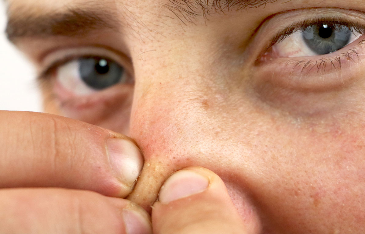 Mụn đầu đen li ti ở sống mũi