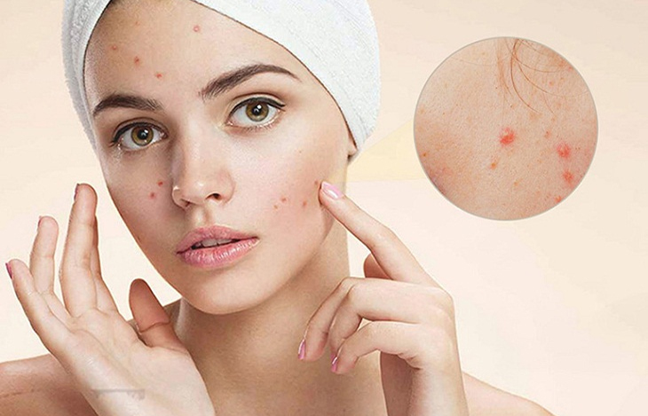  Triệu chứng khi da mặt bị khô mụn