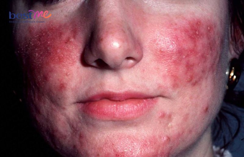 Cấp độ 5 nhiễm corticoid